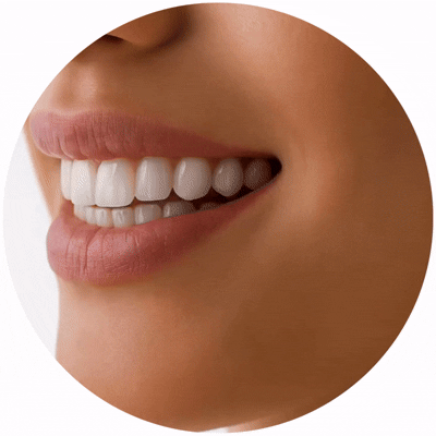Clareamento Dental