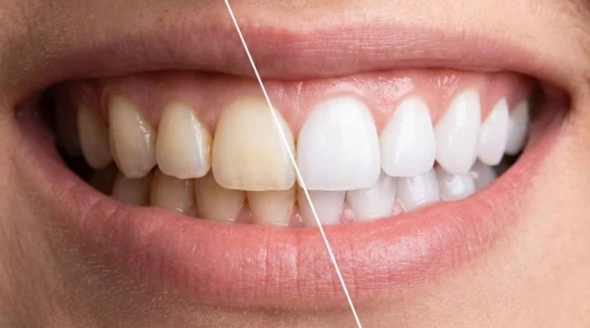 Clareamento Dental Estético
