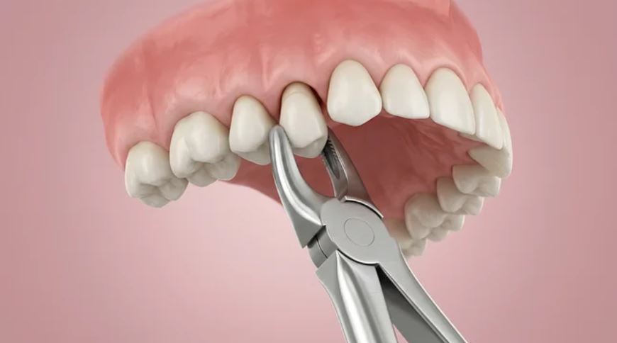 Extração Dentária e Siso