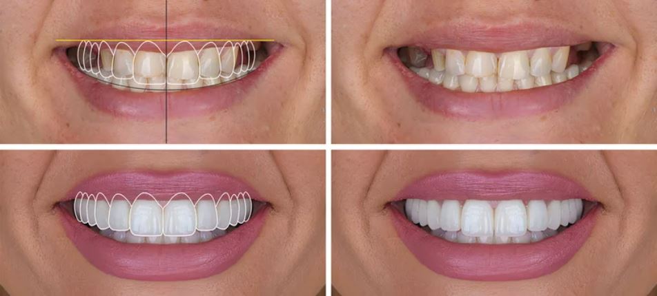 Lentes de Contato Dental e Facetas