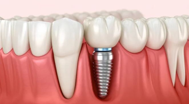 Implante Dentário em Titânio
