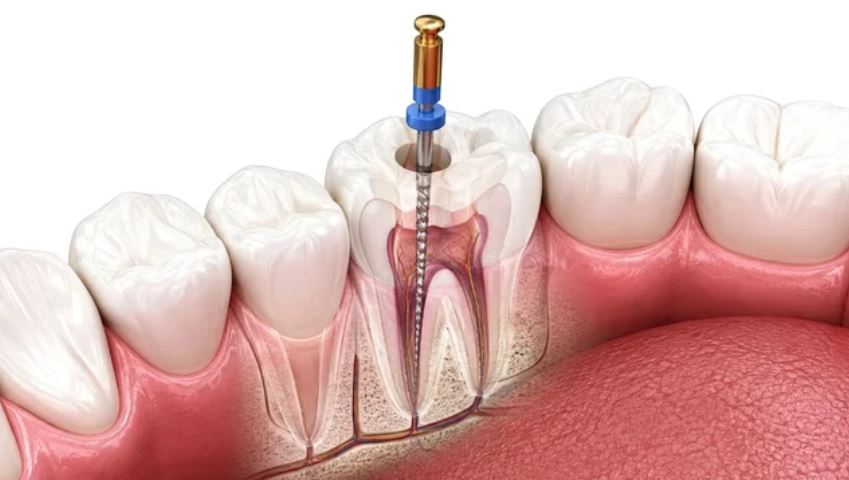 Tratamento de Canal Endodontia